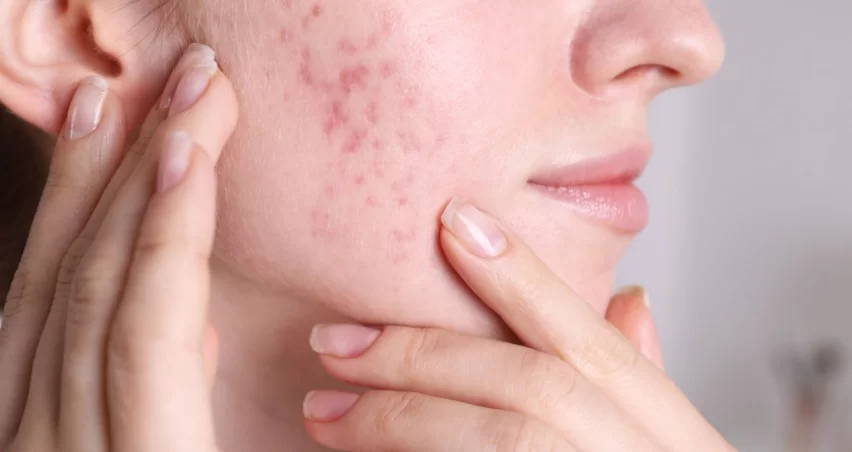 Tratamento de acne adulta